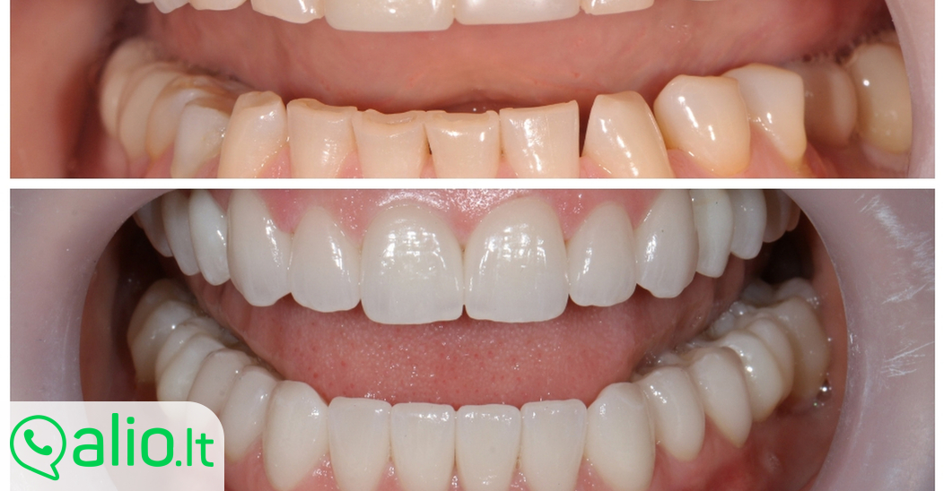 Estetinis dantų protezavimas laminatės skelbimo ID58539329 Nuotraukos